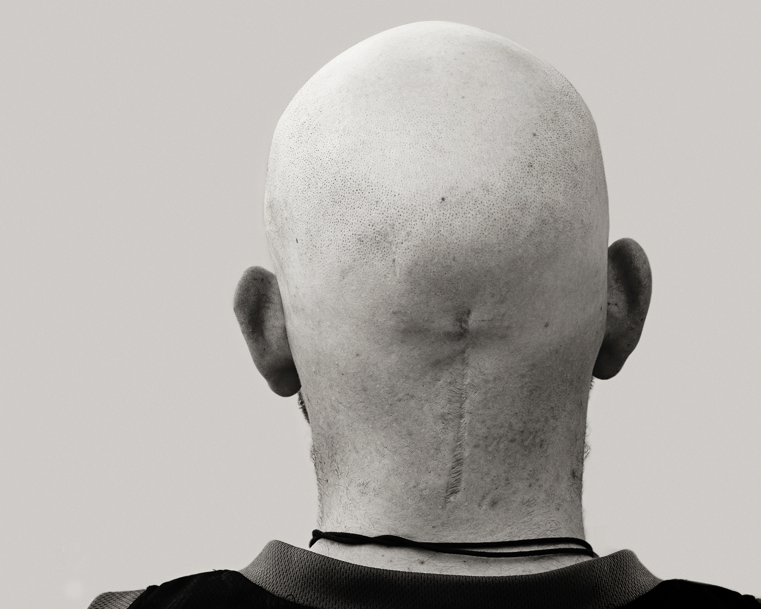 Scar Stories Craig Brain Tumour by Brihanna Rilstone.jpg