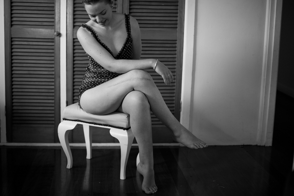 Scar Stories Jasmine Osteosarcoma by Georgia Brizuela 2.jpg