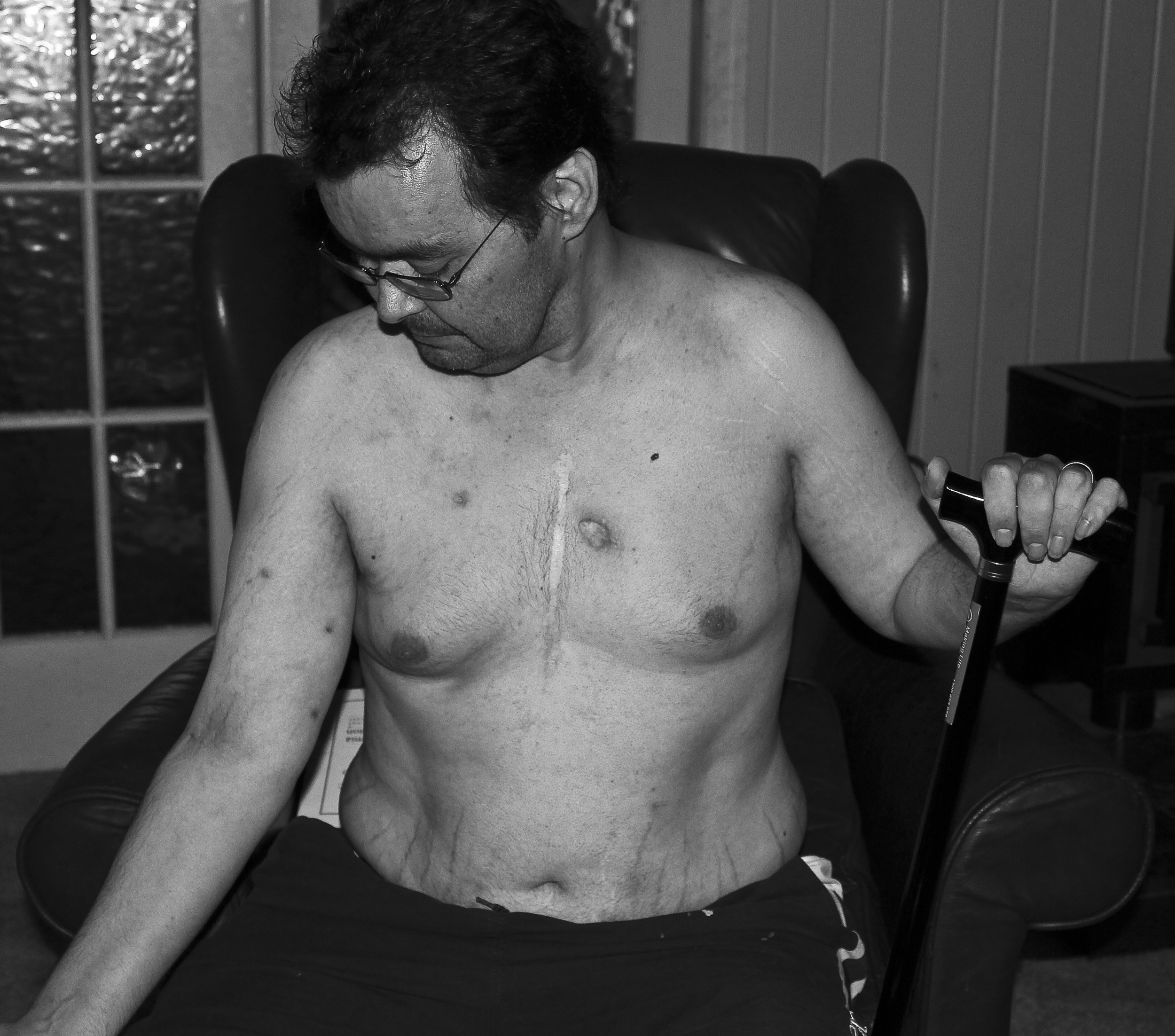 Scar Stories John Nonhodgkins Lymphoma by Michelle Watters.jpg